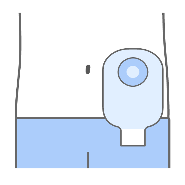 人口肛門の管理